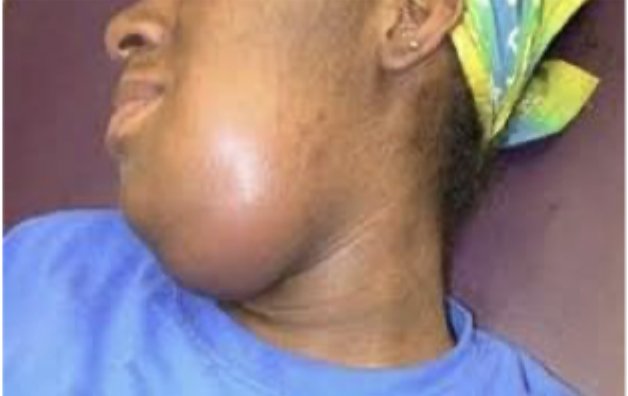 <p>Patient presents to the ER with respiratory distress. Patient is drooling and has muffled voice. She reports fever, chills, malaise, mouth pain, and a stiff neck. On a physical exam you note edema of the upper neck and displacement of tongue up and backward. Vitals are stable with the exception of fever. What is our treatment plan?</p>