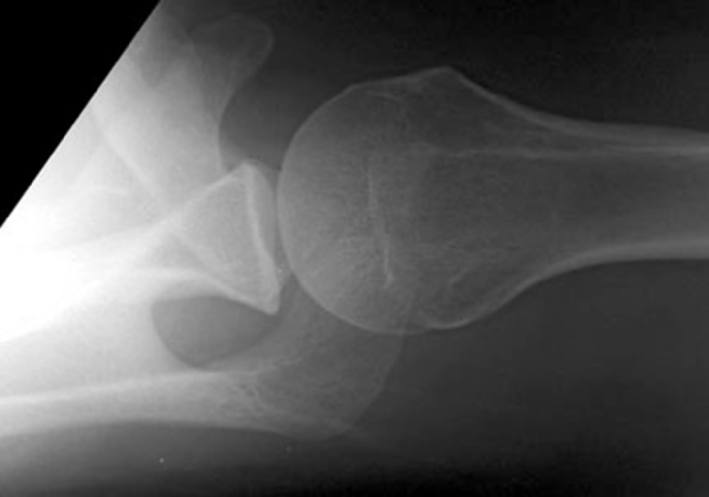 <p>Which types of x-ray views are common at the shoulder?</p>