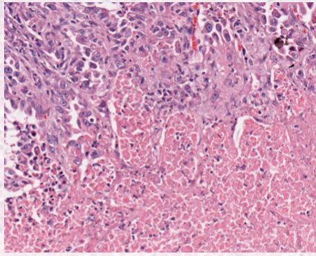 <p>protein denaturation </p><p>retention of cellular borders </p><p>ischemia </p>