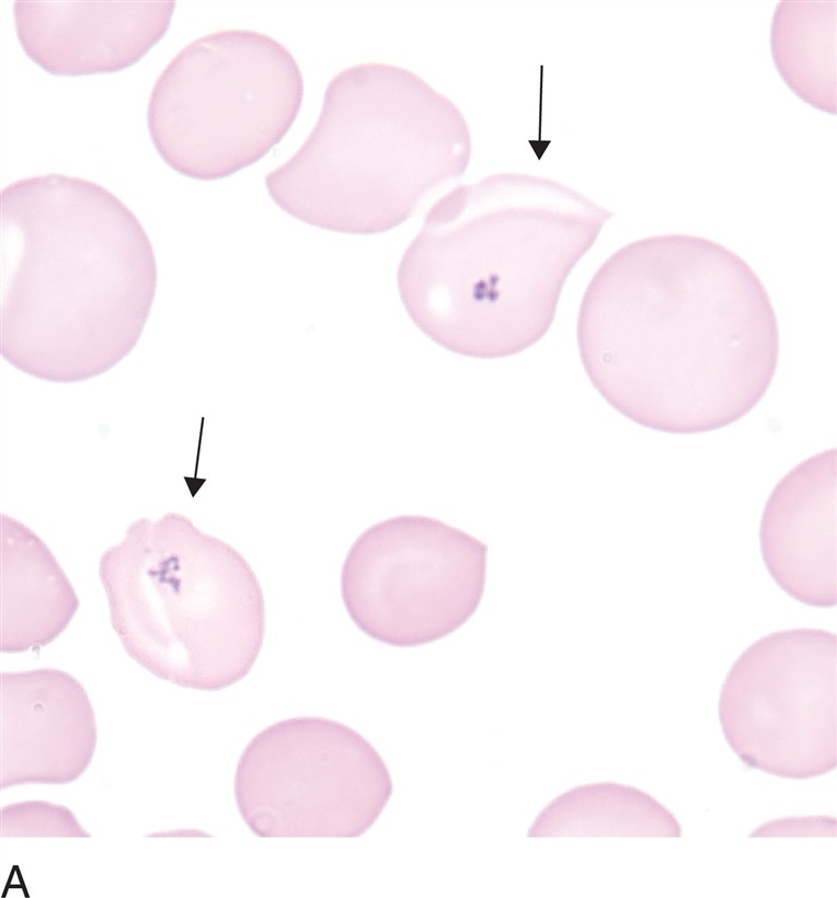 <p>what are pappenheimer bodies? (RBC inclusions)</p>