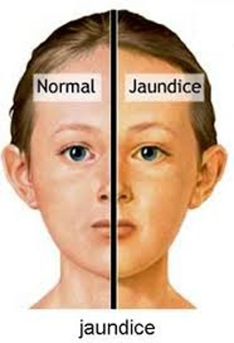 <p>-excess bilirubin in the bloodstream -> yellowish discoloration of skin and mucosa</p><p>-increased bilirubin production or impaired liver fx</p>