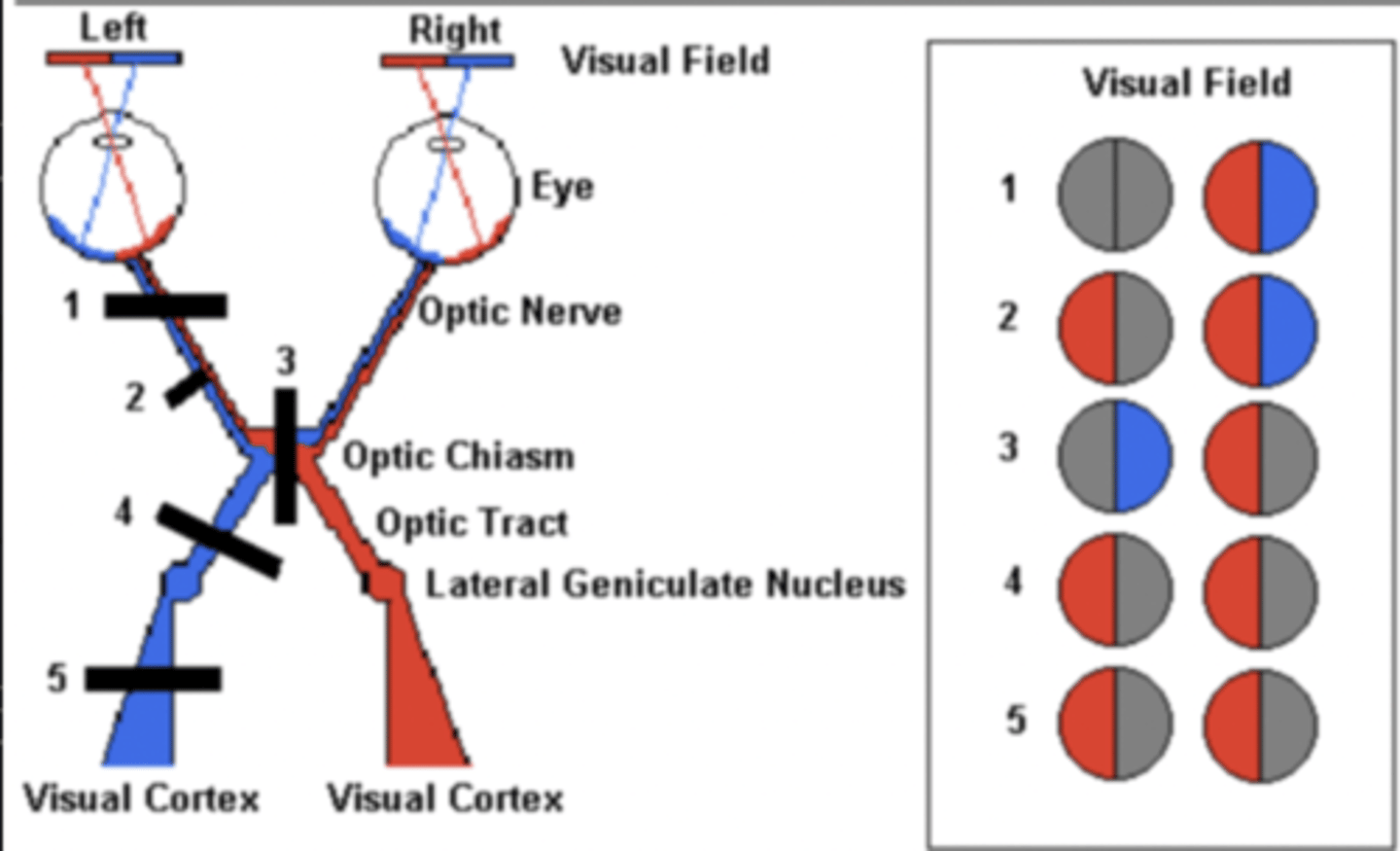<p>Inability to see thru the lateral portions of the left and right eyes<br>(#3)</p>