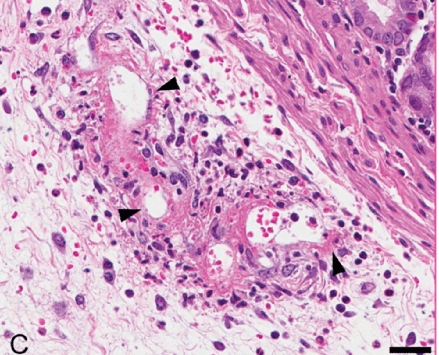 <p>describe the extracellular accumulation</p>