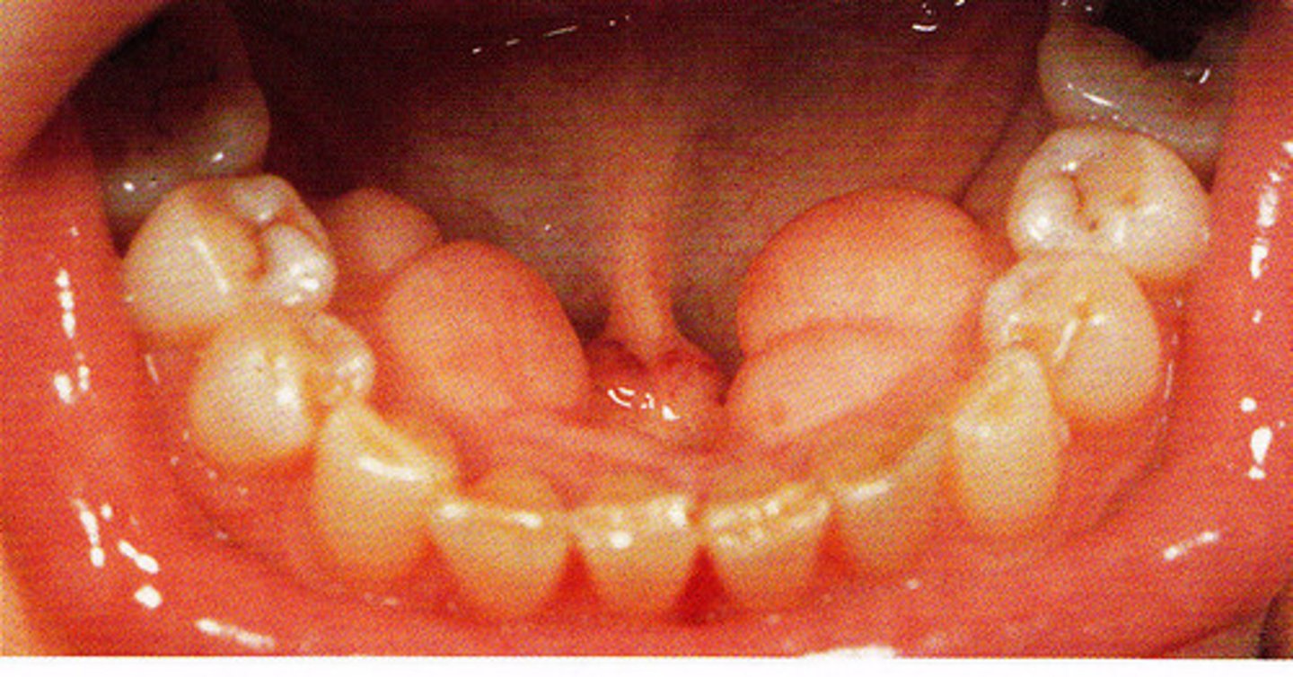 <p>Mandibular Tori</p>