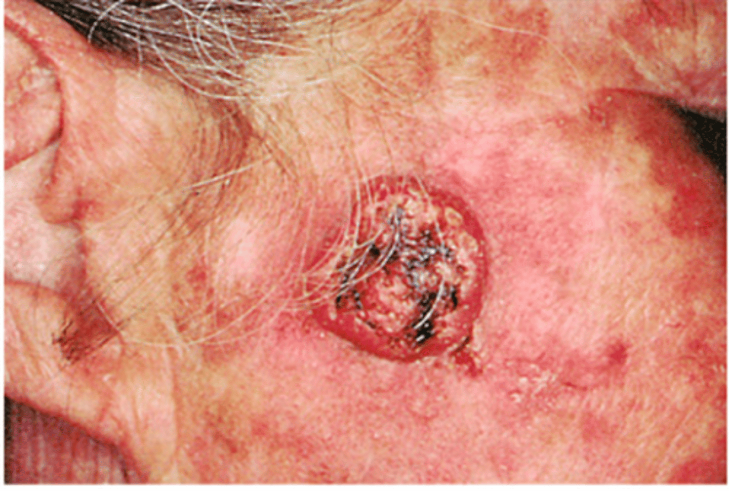 <p>-2nd most common form of skin cancer</p><p>-Head and neck (most common places)</p><p>-Result of excess sun/ultraviolet light exposure</p><p>-Predominantly common in whites</p><p>Treated:</p><p>-Chemically</p>