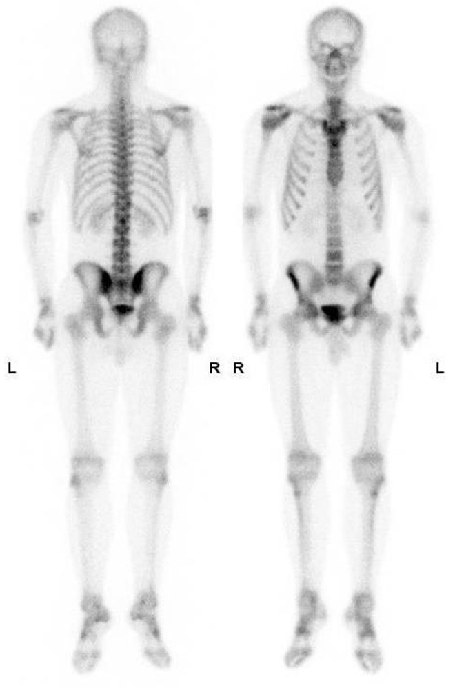 <p>Bone Scans </p>