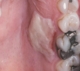 <p>caused by contact with hot beverages and food</p>