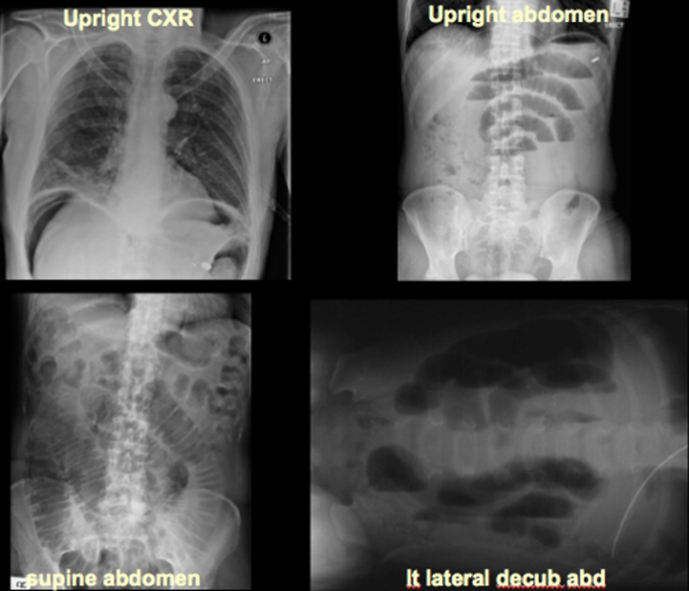 <p>supine abdomen/KUB/scout - bowel gas pattern, calcifications, masses</p><p>upright abdomen - free air, air-fluid levels</p><p>upright chest - free air, pneumonia, pleural effusions</p>