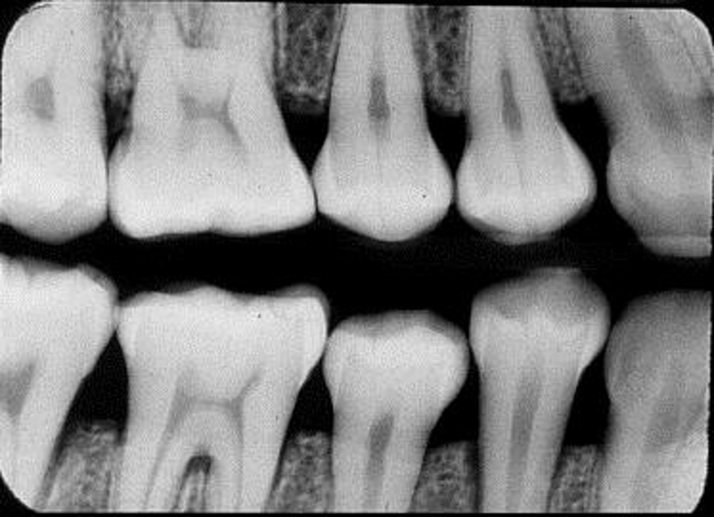 <p>Premolars projection</p>