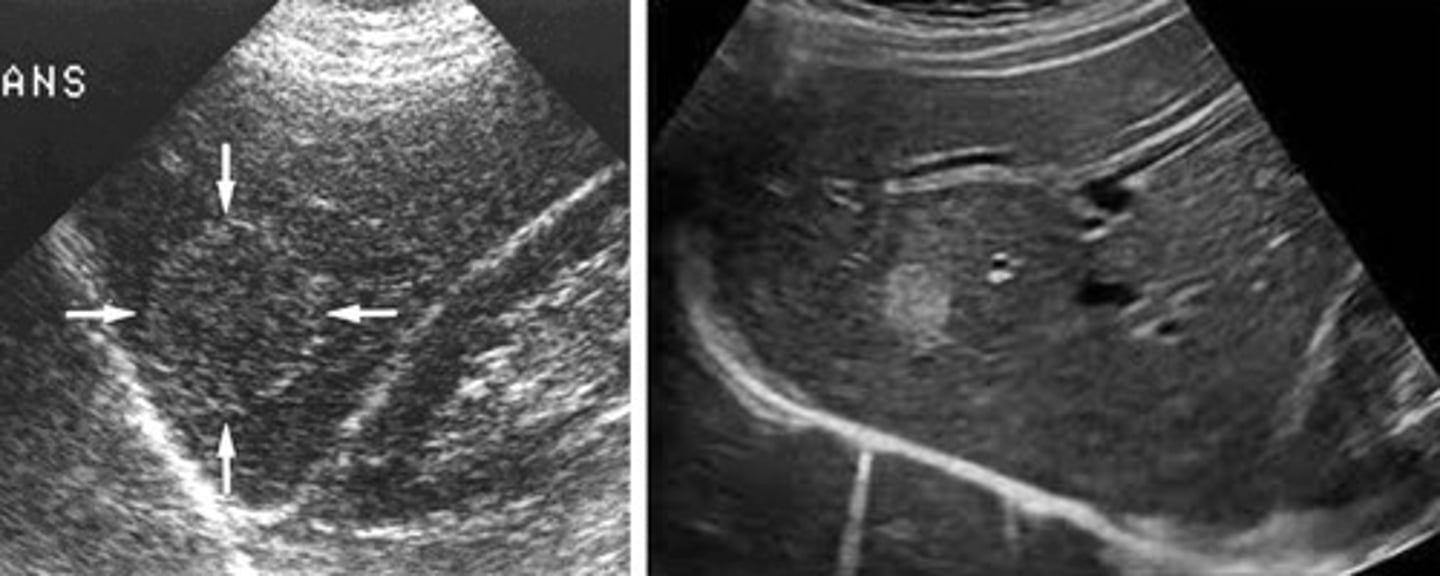 <p>Small - 1-3 cm</p><p>Homogenous</p><p>Posterior enhancement</p><p>Well defined margins</p>