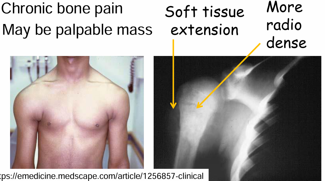 <ol><li><p>Chronic bone pain</p></li><li><p>May be palpable mass</p></li><li><p>Soft tissue extension</p></li><li><p> More radio dense</p></li></ol><p></p>