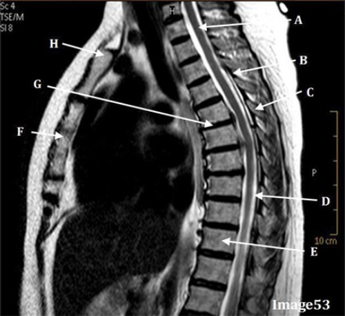 <p>Letter A in Image 53 is pointing to:</p><p>A. Ligamentum flavum</p><p>B. Spinous ligament</p><p>C. Spinal cord</p><p>D. Cerebrospinal fluid</p><p>E. spinous process</p>