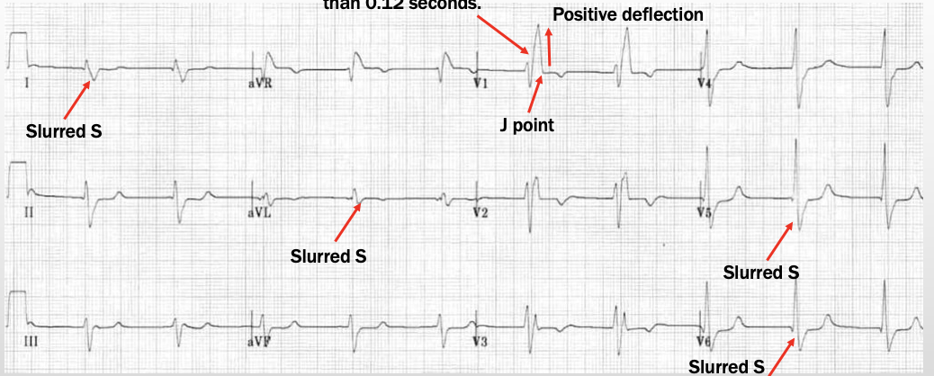 <p>Lead V1: wide QRS, rSR pattern (M) (usually V1-3)</p><p>Lateral: slurred S (sometimes W seen)</p>