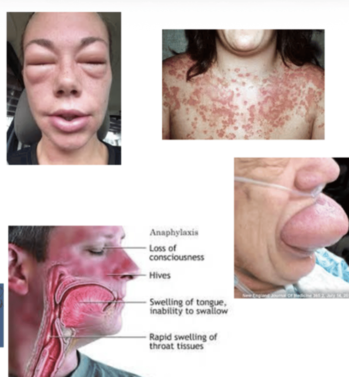 <p>A: They cause vessel dilation and increase permeability. the combination of vasodilation and fluid leakage can cause rapid cardiovascular collapse and airway obstruction, which are hallmarks of anaphylactic shock.</p>