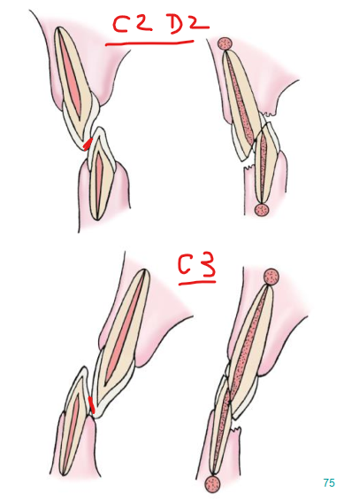 <p><strong>Class 2 Div 2 </strong>= incisal wear causing exposure and death of the tooth pulp</p><p><strong>Class 3</strong> = incisal wear causing pulp exposure </p>