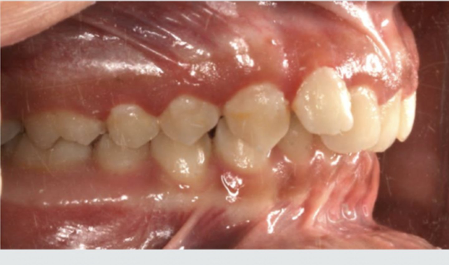 <p>Class II division 2</p>