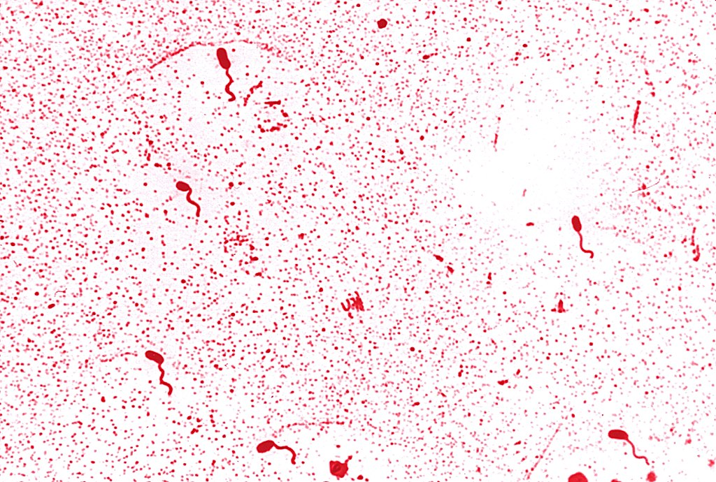 <p><strong>Pink curved rods (Gram-negative comma-shaped bacilli).</strong></p><p>Type: Bacteria;</p><p>Disease: Cholera (severe watery diarrhea, "rice water stools");</p><p>Diagnosis: Stool culture, rapid test, symptoms of dehydration;</p><p>Treatment/Prevention: Oral rehydration, IV fluids, doxycycline; vaccines available;</p><p>Spread/Unique: Contaminated water/food; produces cholera toxin → massive water loss from intestines.</p>