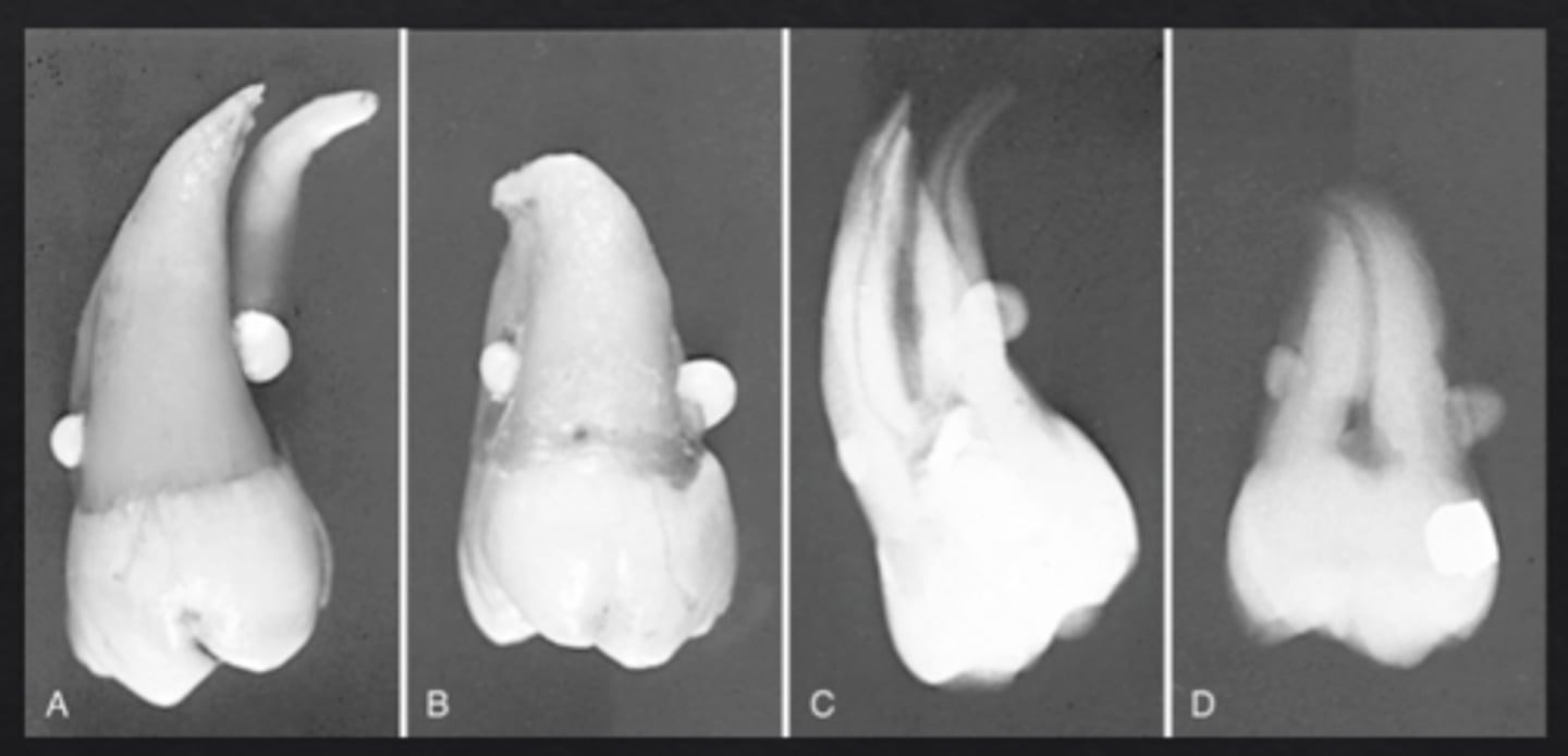 <p>Small globule of enamel on the root surface or CEJ</p>