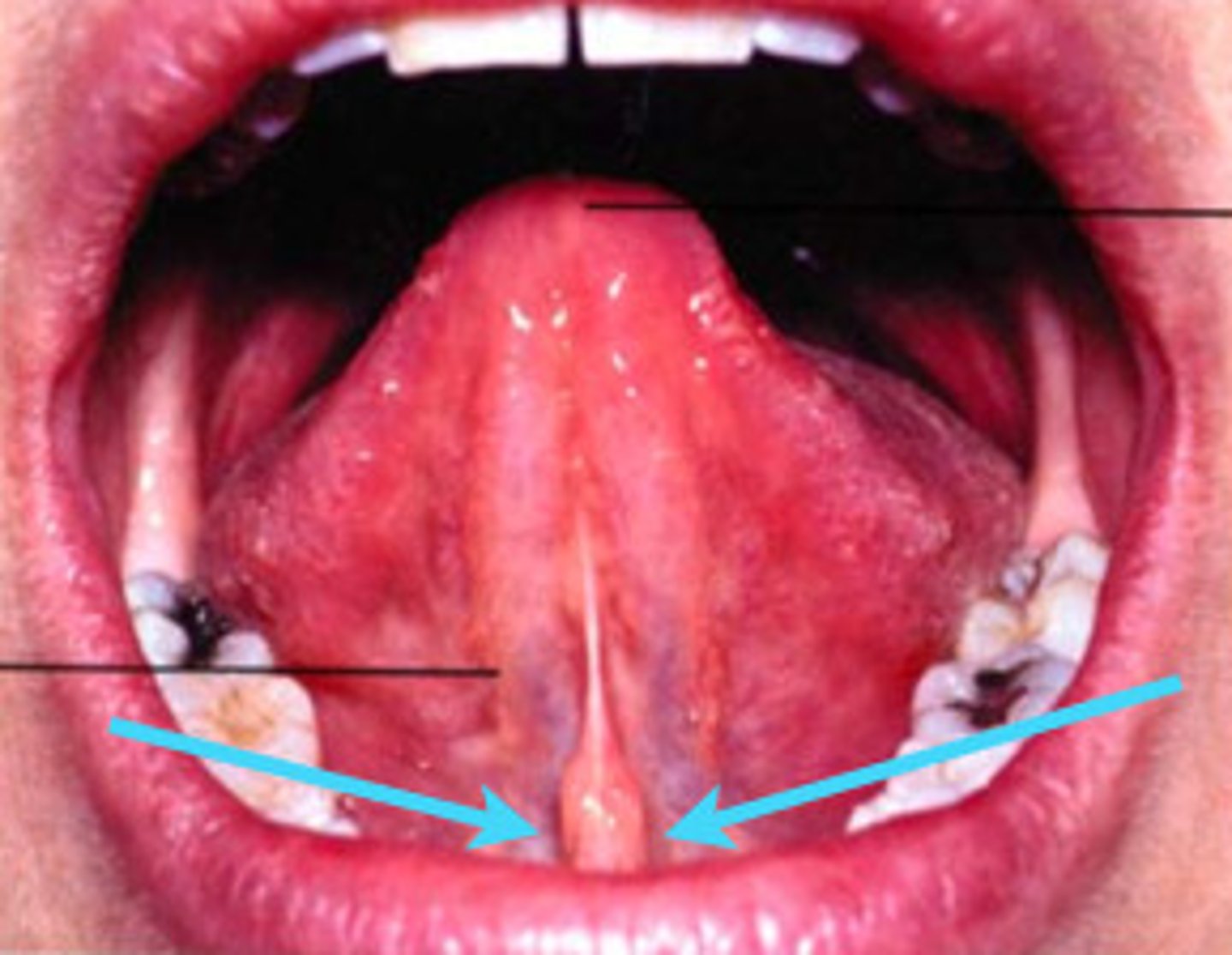 <p>Structure on the floor of the mouth that is a small papilla on the lingual frenum, acting as duct openings for submandibular and sublingual salivary glands.</p>