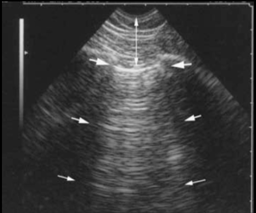 <p>What type of artifact looks like a series of hyperechoic horizontal parallel line at regularly spaced intervals?</p>