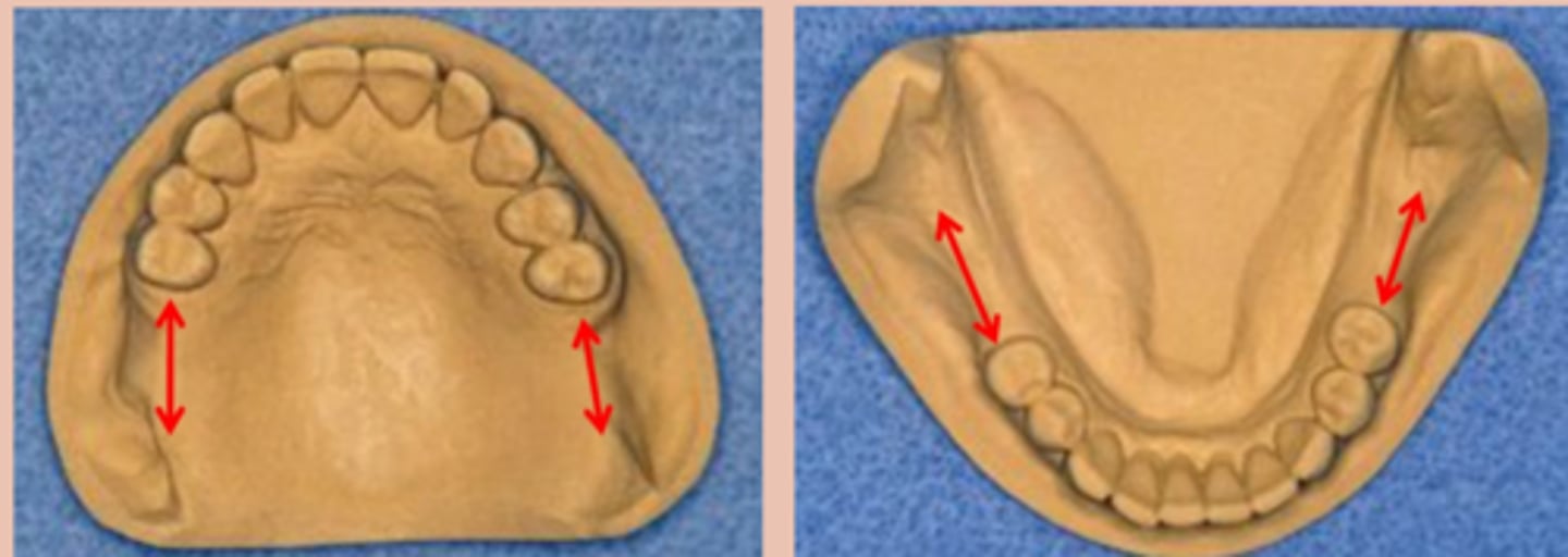 <p>Tooth and tissue supported:</p><p>bilateral edentulous area posterior to natural teeth</p>