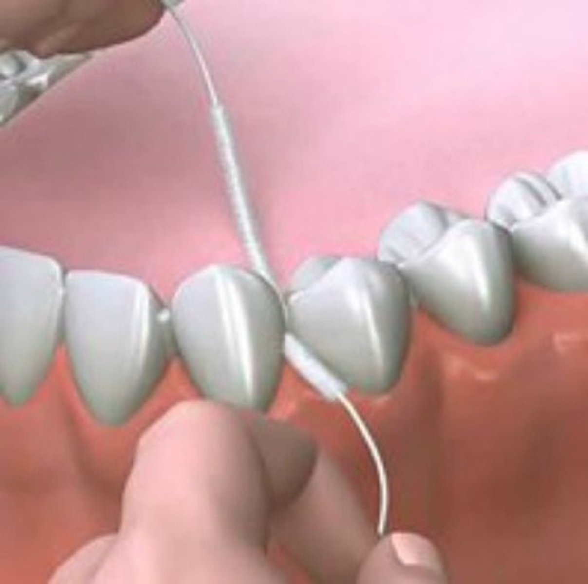 <p>it is a dichotomy index used to estimate gingivitis, so it is not very sensitive</p>
