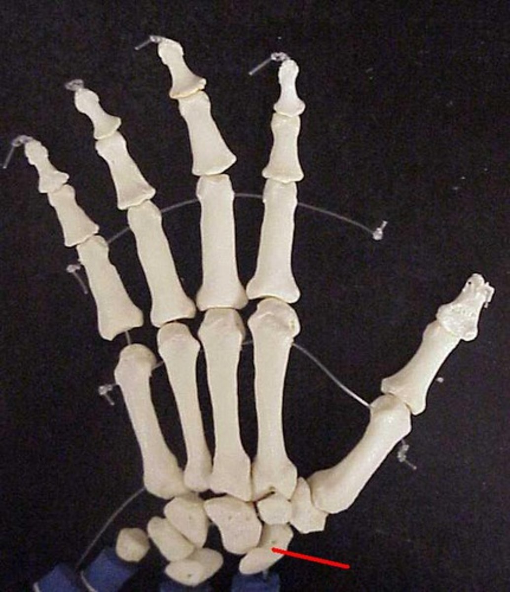<p>Scaphoid of carpal</p>