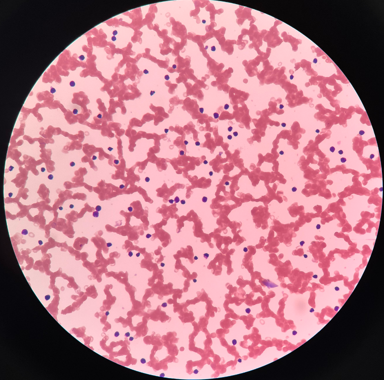• Cancer of the blood-forming tissue in bone marrow and lymphatic tissue.

• Marked by uncontrolled production of immature leukocytes.

• Acute and chronic variants.