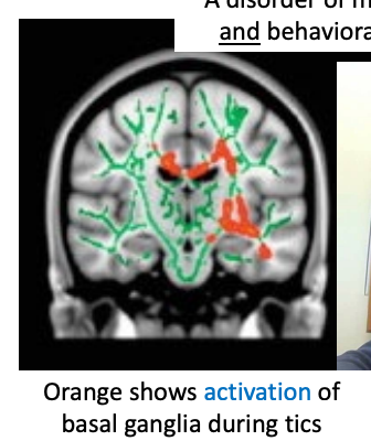 <p>Disorder of motor and phonic tics & behavioural/cognitive deficits</p>
