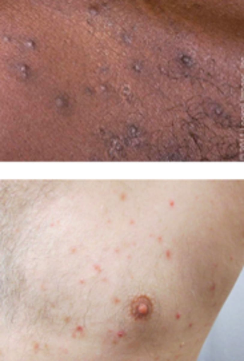<p>Bacterial ID:</p><p>Subjective:</p><p>Rash or “bumps” that can be painful, pruritic, or both</p><p>Objective:</p><p>- Follicular pustules and inflamed, follicular papules</p><p>Common sites:</p><p>- Scalp, face, upper trunk, buttocks, legs, axillae (younger pt)</p><p>Pruritus is common</p><p>Tender lesions may be present</p>