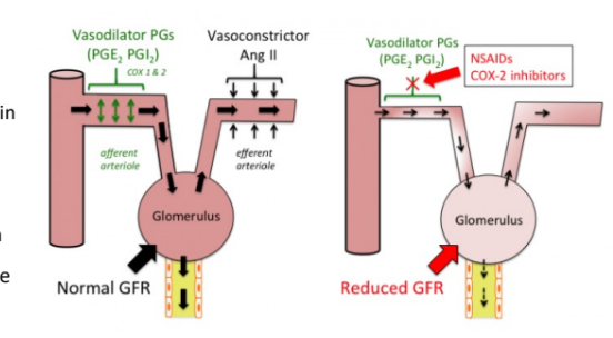 <ul><li><p>Avoid if possible (stop vasodilation of afferent arteriole which leads to reduction of blood flow to the glomerulus</p></li></ul><p>• Prostaglandin synthesis inhibited, effecting renal perfusion –especially in those with renal disease</p><p>NSAIDs work by inhibiting prostaglandins, which normally help maintain blood flow to the kidneys. When prostaglandins are blocked, the blood vessels supplying the <strong>glomerulus</strong> constrict, leading to reduced blood flow. This lowers the <strong>glomerular filtration rate (GFR)</strong>, which measures how well the kidneys filter waste from the blood.</p>