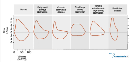 <p><span>Flow volume loops provide a graphical illustration of a patient's spirometry efforts.</span></p>