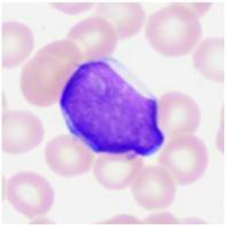 <p>3 yo female presents with exertional dyspnea, fever, petechiae & gingival bleeding, and headache. She is <strong>febrile and anemic</strong> (hematocrit 25%, normal range 36-54%) and has a WBC count of 20,000/mm³ (normal range 8-10,000). She has generalized <strong>lymphadenopathy (enlarged lymph nodes) & splenomegaly</strong>. The peripheral revealed numerous immature blasts with <strong>scant agranular cytoplasm</strong>. What is most likely the diagnosis?</p>