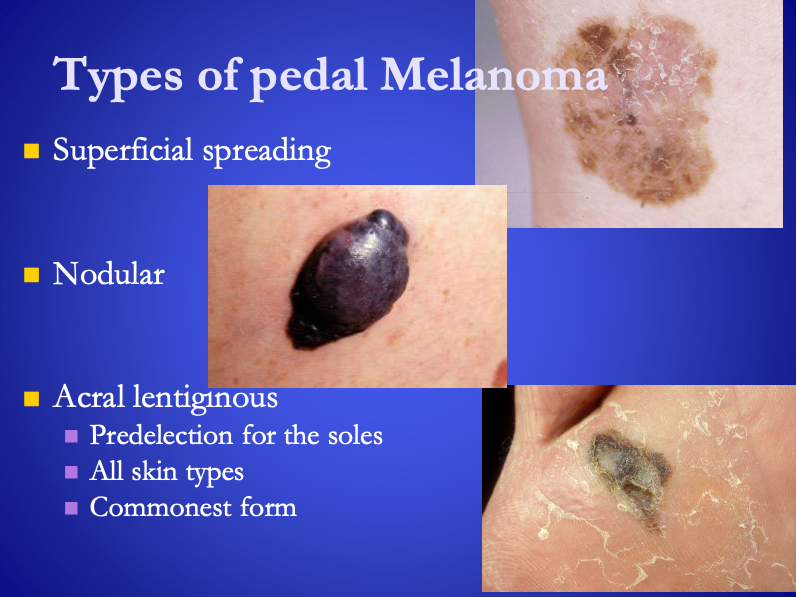 <p>Types of Pedal Melanoma</p><ol><li><p><span><strong>[...]</strong></span></p></li><li><p><span><strong>[...]</strong></span></p></li><li><p><span><strong>[...]</strong></span> (most common)</p></li><li><p><span><strong>[...]</strong></span>&nbsp;</p></li></ol><p></p>