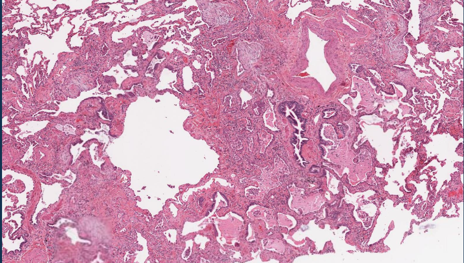 <p>¿A qué se le denomina fibrosis en panal de abeja?</p>
