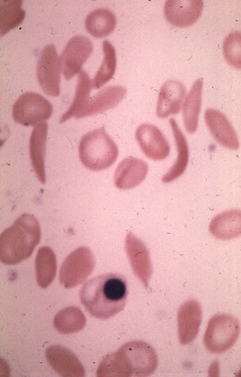 <p>an autosomal recessive anemia due to substitution of a single amino acid (valine for glutamic acid) characterized by red blood cell becoming sickle-shaped and non-functional.</p>