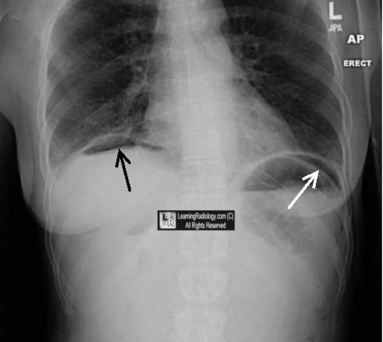 <p>What is indicated by the white arrow?</p>