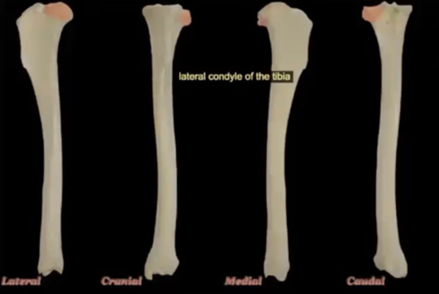 <p>lateral, smaller condyle of the top of the tibia; on the side of fibula</p>