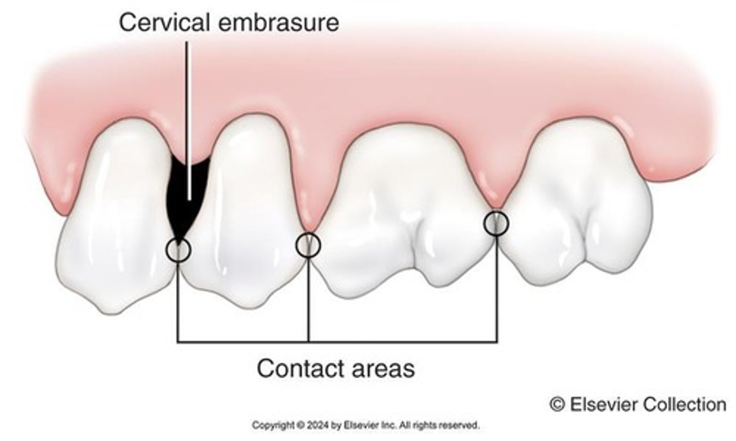 <p>A space that occurs when there is gingival recession between teeth, resulting in missing interdental papilla and bone.</p>