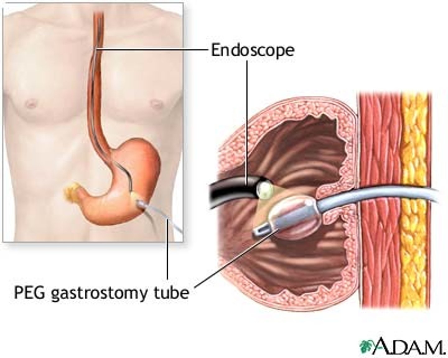 <p>can be placed by surgery, by endoscopy, by radiology</p>