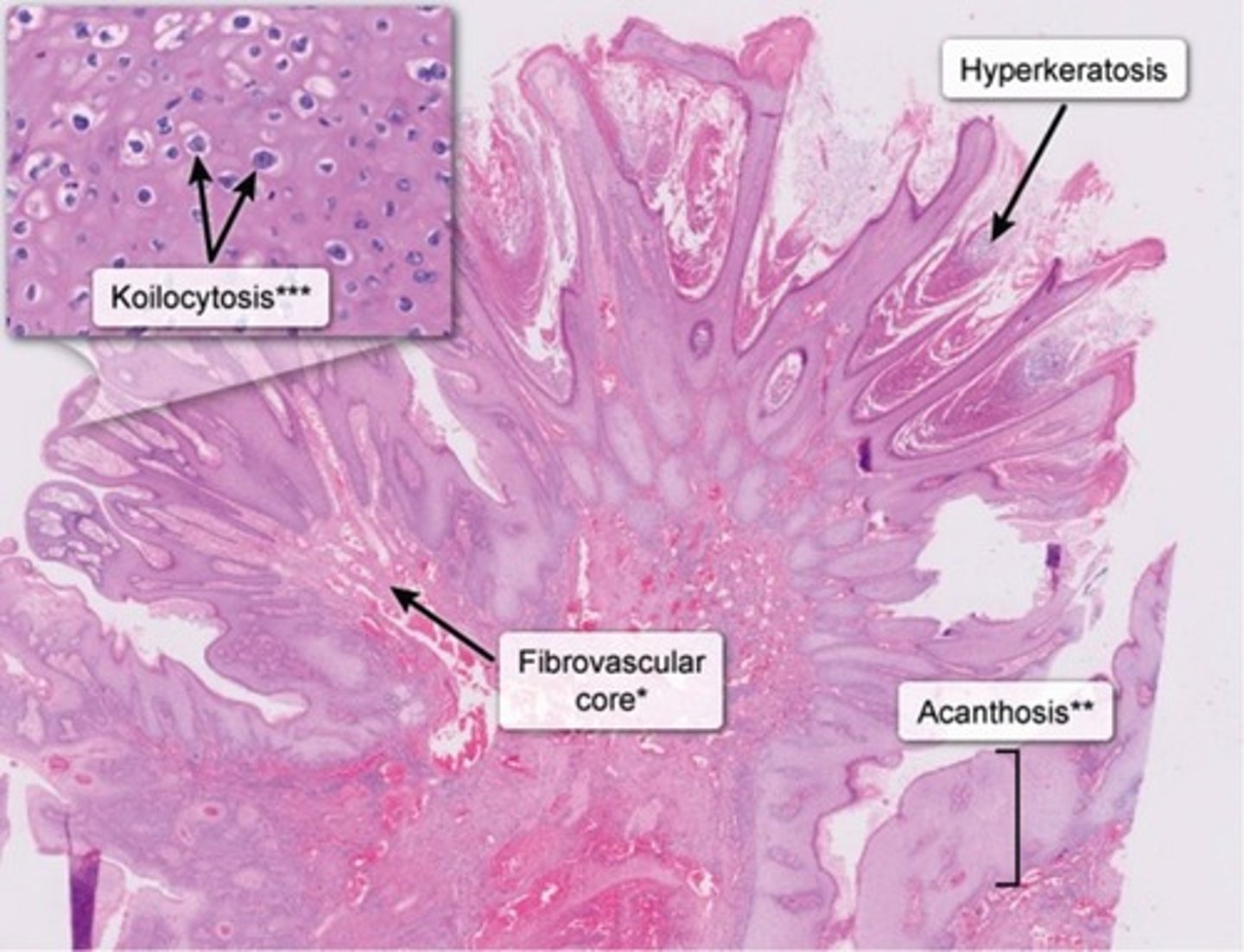 <p>Etiology</p><p>-HPV 6 + 11</p><p>Transmission</p><p>-Sexual contact in adults → Affects True Vocal Cords</p><p>Histo</p><p>-Hyperplastic papillary Squamous epithelium with Parakeratosis</p><p>-Nuclear irregularity and Perinuclear Halos</p><p>Sx</p><p>-Thickening of Stratum Corneum</p><p>**Must test pt for HIV!**</p>