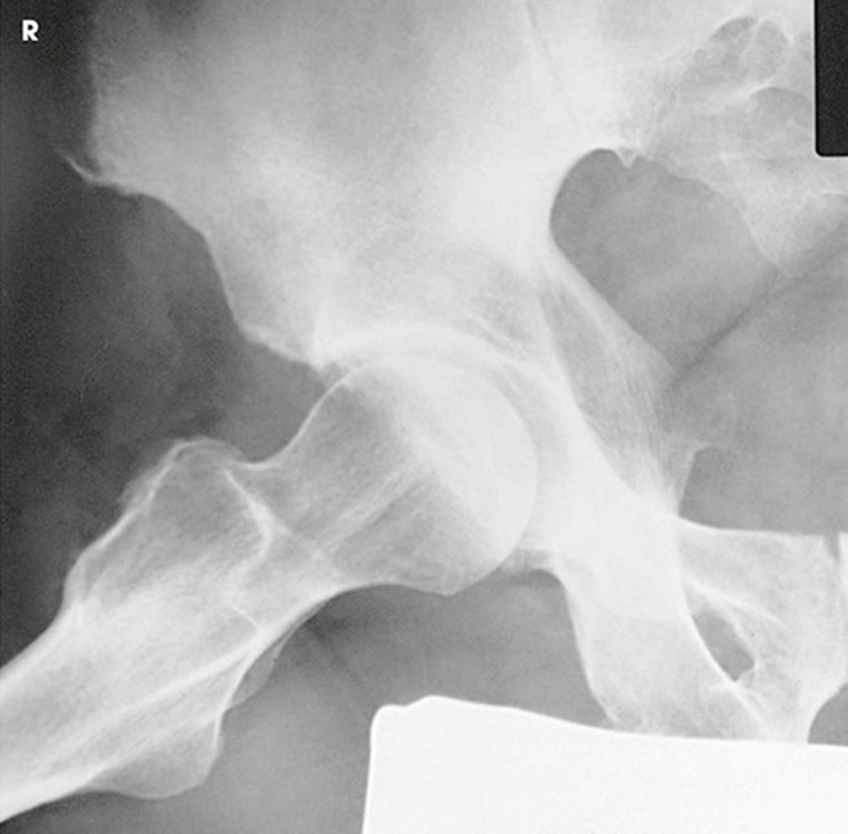 <p>CR perpendicular to the femoral neck</p>