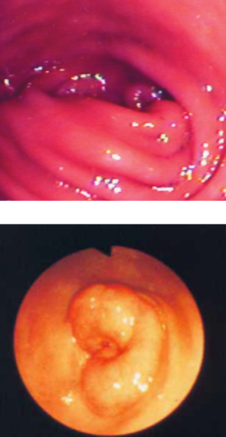 <p>1. muscular</p><p>2. mucosal</p>