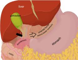 <p>omental (epiploic) foramen </p>