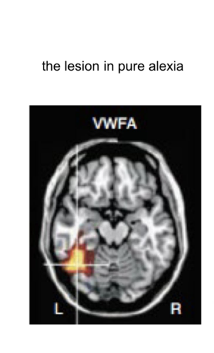 <p>Lesion in Pure Alexia (Pic)</p>