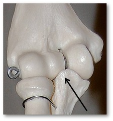 Name this specific part of the ulna.