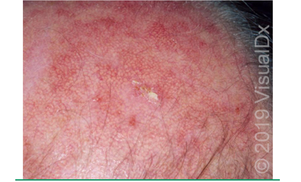 <p>cutaneous lesion that results from proliferation of atypical epidermal keratinocytes; <strong>precursor lesion to SCC</strong></p>