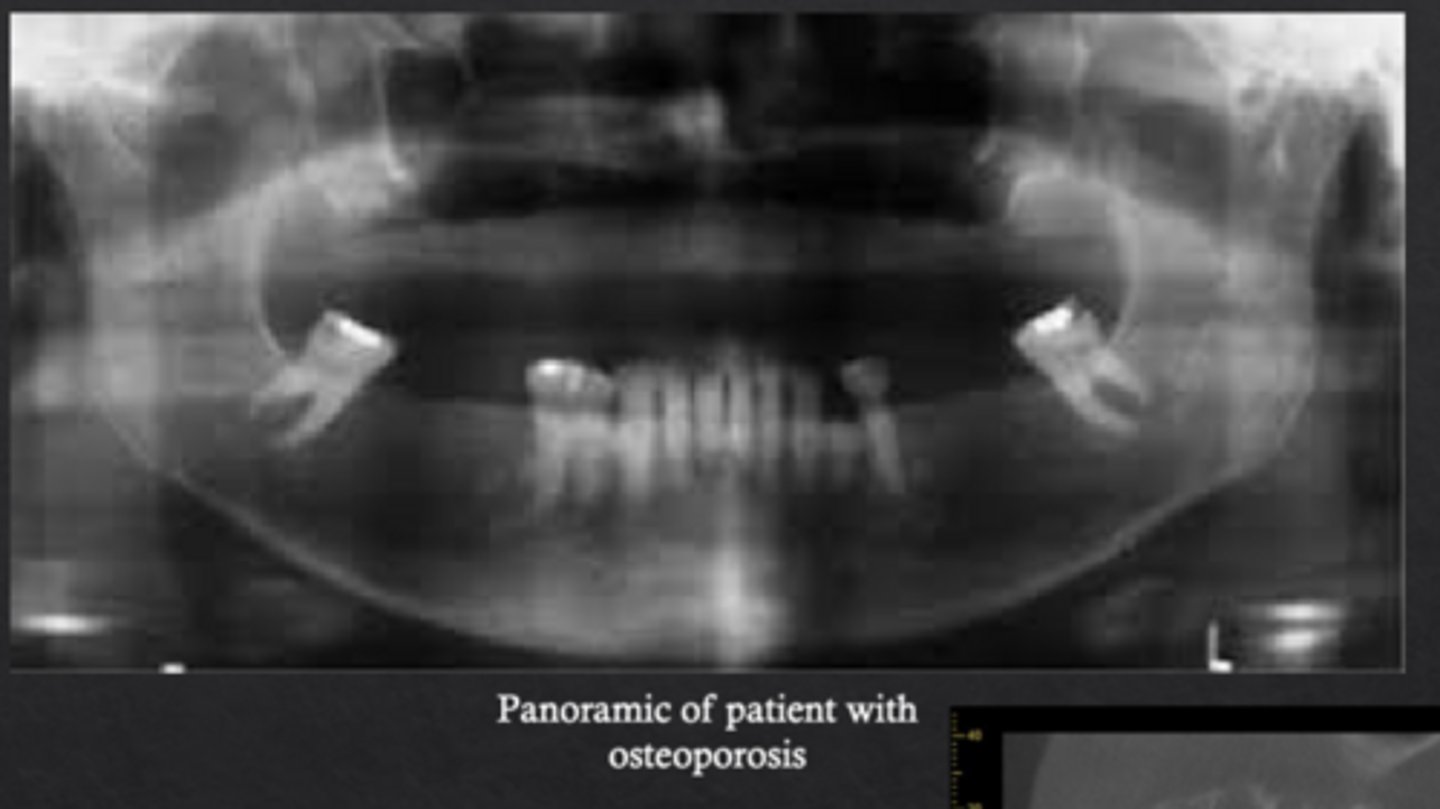 <p>Loss of trabecular architecture and thinning of mandibular cortical bone</p>