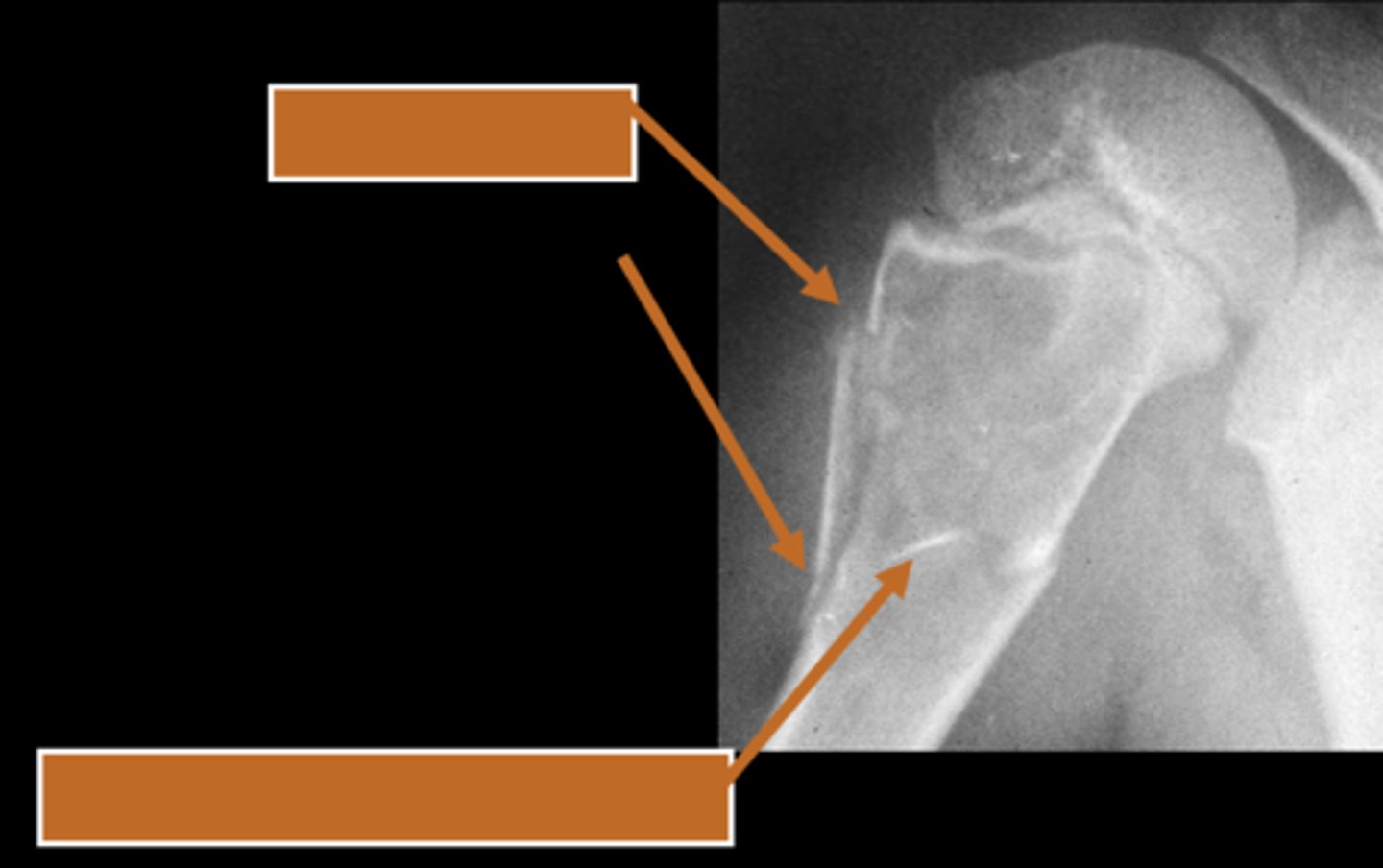 <p>ID radiographic feature of simple bone cyst indicated by the top arrow</p>