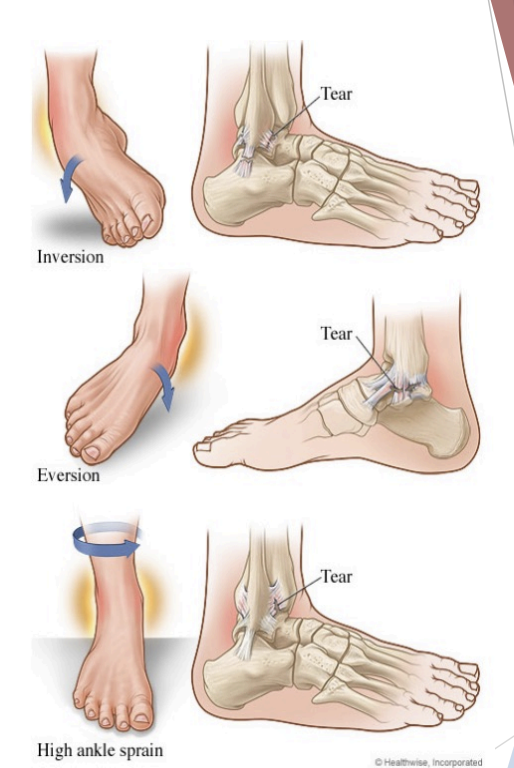 <p>Sprain</p>